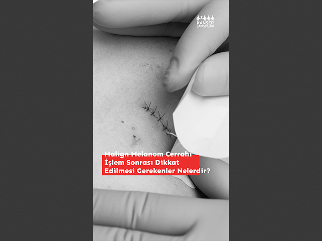 Malign Melanomda Cerrahi İşlem Sonrası Dikkat Edilmesi Gerekenler Nelerdir?
