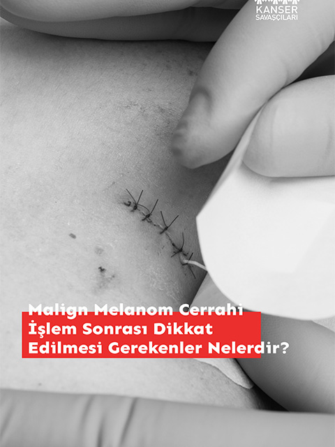 Malign Melanomda Cerrahi İşlem Sonrası Dikkat Edilmesi Gerekenler Nelerdir?